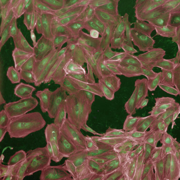 Gene expression analysis for classifying cancer stages